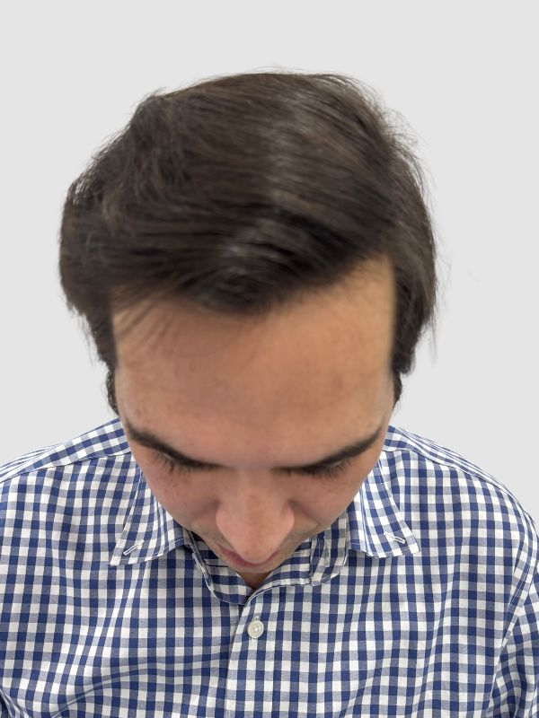 anterior de cliente sin cabello